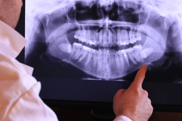 Best Emergency Root Canal Treatment in Indialantic, FL